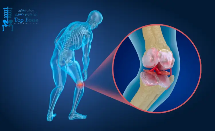 افضل طرق علاج تآكل الغضاريف بدون تدخل جراحي باحدث التقنيات