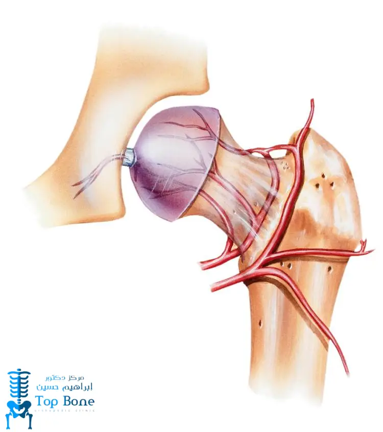 علاج نخر عظم الورك: الأسباب، الأعراض، وأحدث طرق العلاج