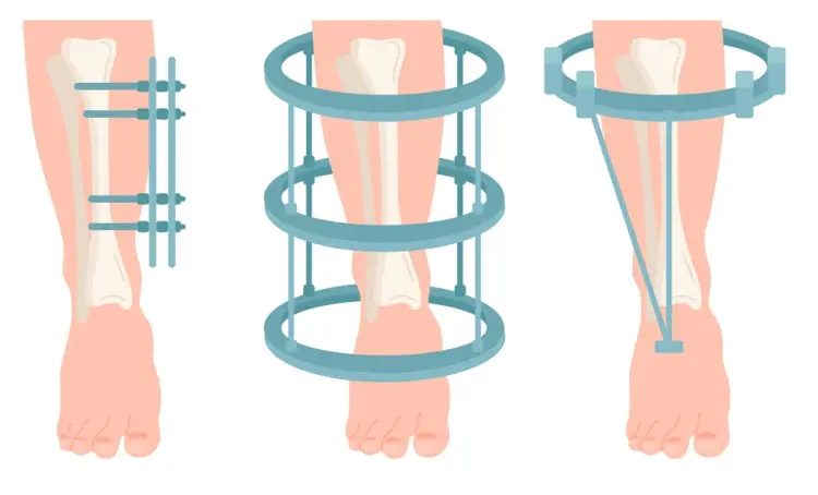 تكلفة عملية زيادة الطول 2026: العوامل المؤثرة ونتائج العملية