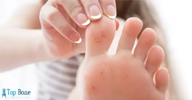 أفضل طرق علاج مسمار القدم نهائيًا وأسباب ظهوره والوقاية منه