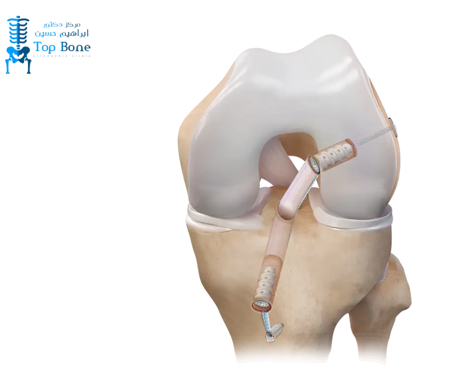 سعر فليبوتون للركبه في مصر 2026 | اهميتها لعلاج خشونة الركبة