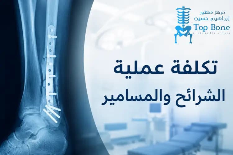 تكلفة عملية الشرائح والمسامير في مصر 2026 | العوامل المؤثرة
