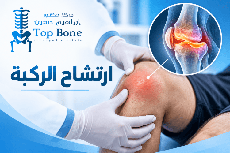 ارتشاح الركبة: الأسباب والأعراض وطرق العلاج والوقاية الكاملة