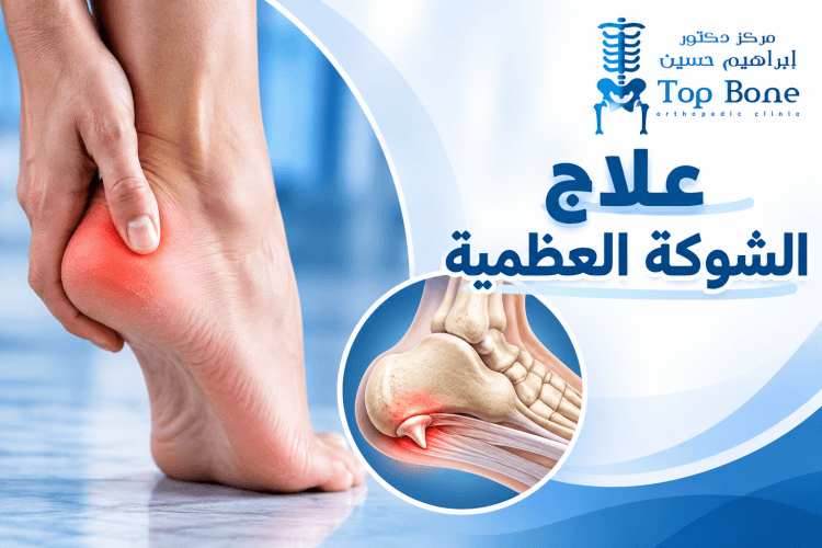 علاج الشوكة العظمية وأسبابها وطرق التخلص من ألم الكعب نهائيا