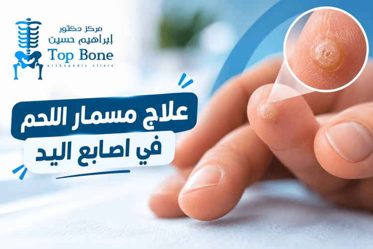 أفضل طرق علاج مسمار اللحم في اصابع اليد نهائيًا بأمان