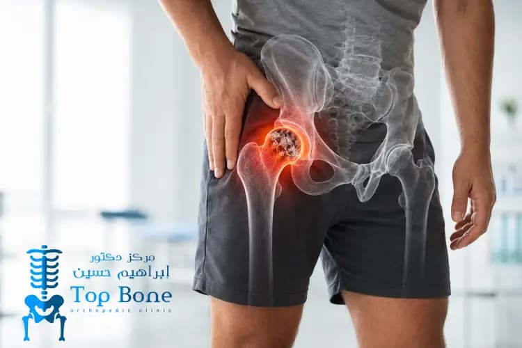 نكروز رأس عظمة الفخذ