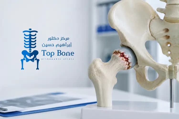 مرض بيرثيز