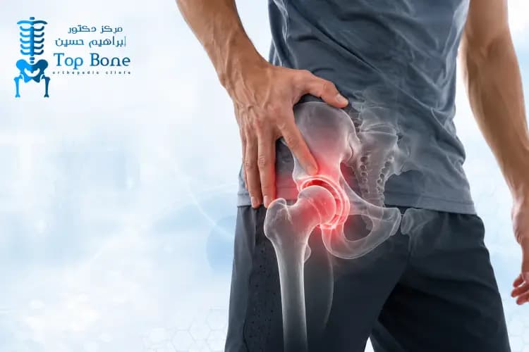 تمزق الشفا الوركي labrum