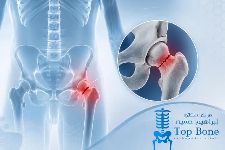 كسر عنق عظم الفخذ