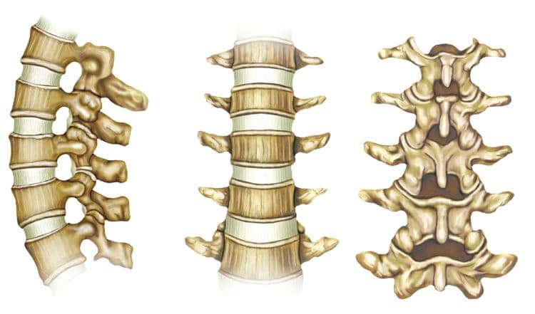 علاج تحرك الفقرة القطنية الخامسة علي العجزية الاولي