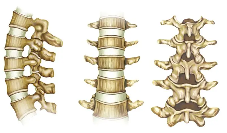علاج تحرك الفقرة القطنية الخامسة علي العجزية الاولي