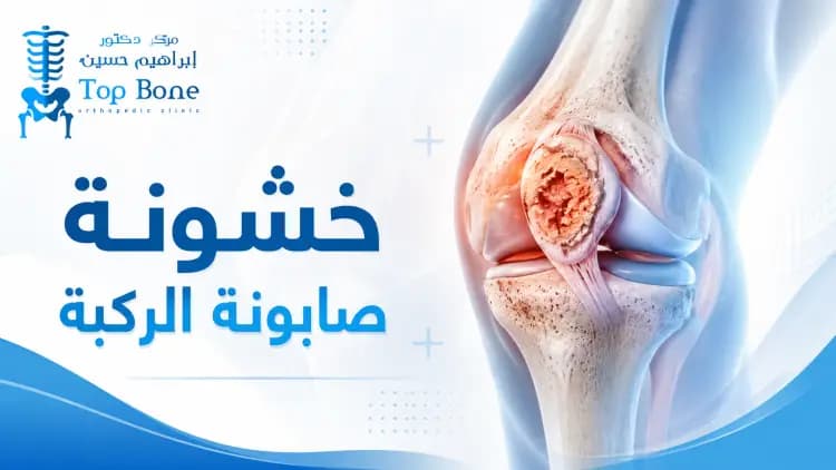خشونة صابونة الركبة: الأسباب والأعراض وأحدث طرق العلاج