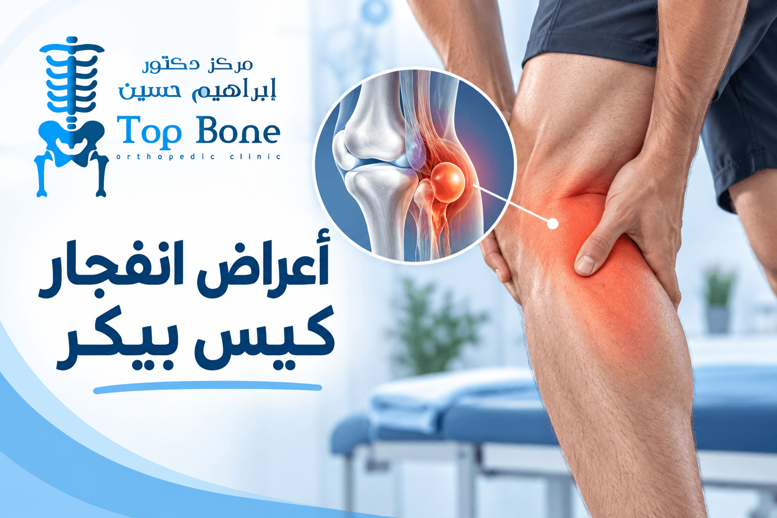 أعراض انفجار كيس بيكر وأهم علامات تمزقه وطرق التشخيص والعلاج