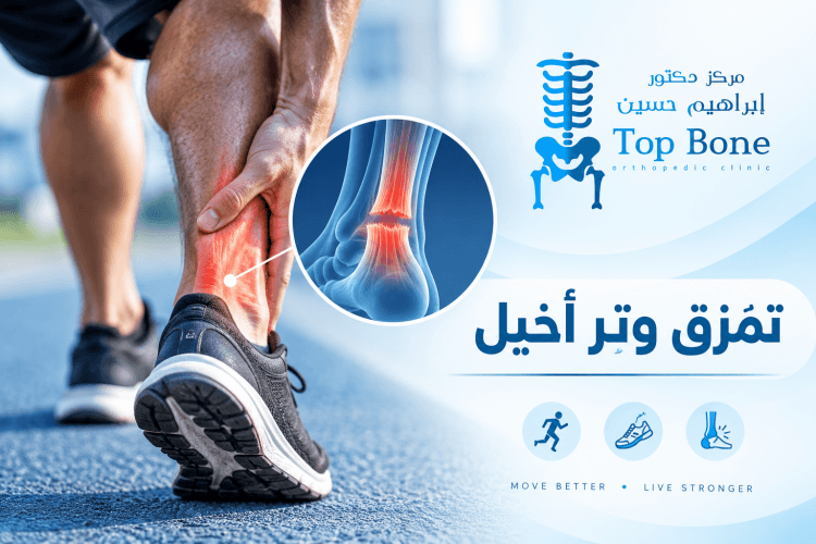تمزق وتر أخيل | خيارات العلاج ومدة الشفاء بعد الإصابة كاملة