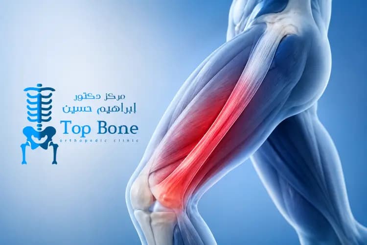 متلازمة الشريط الحرقفي الظنبوبي