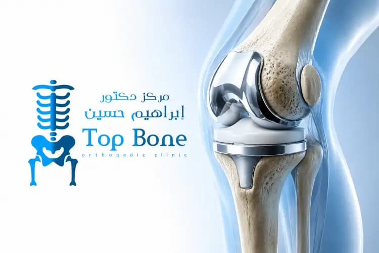 تركيب مفصل الركبة الصناعي