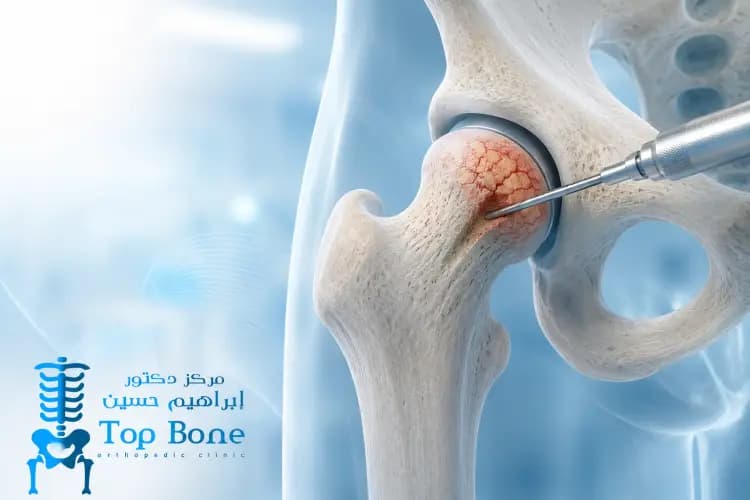 عملية تثقيب رأس عظمة الفخذ