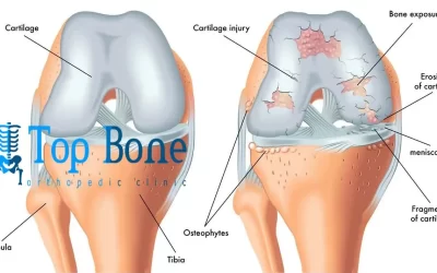 علاج خشونة الركبة نهائيا بدون جراحة ،الاعراض ،الاسباب